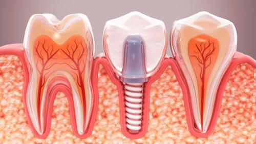 Dental implant diagram lakewood co