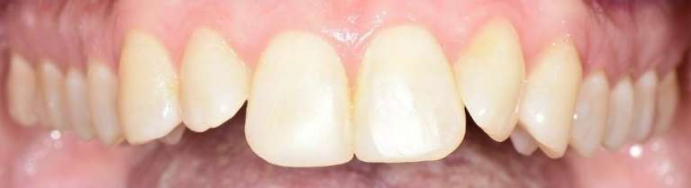 Chipped-Tooth-Repair-with-Composite-Veneers-After-Image