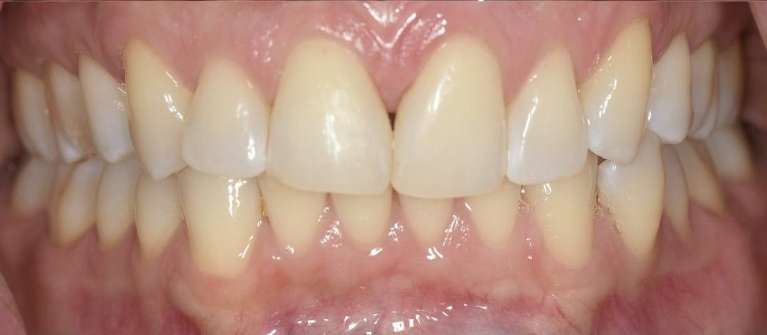 Diastema-Closure-with-Composite-Veneers-After-Image