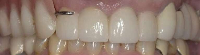 New-Zirconia-Crowns-and-Partial-Denture-After-Image
