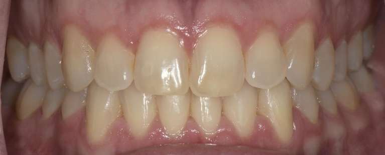 Before-and-After-Ortho-After-Image