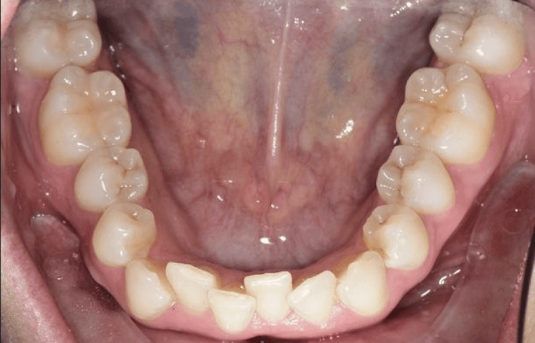 Before-and-After-Ortho-Before-Image