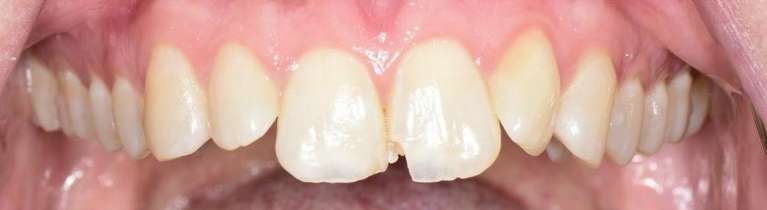 Chipped-Tooth-Repair-with-Composite-Veneers-Before-Image
