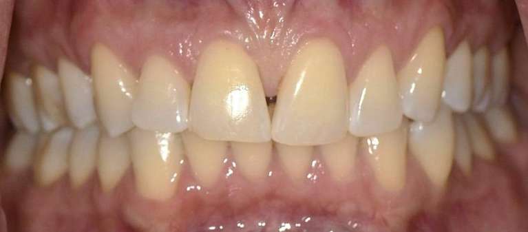 Diastema-Closure-with-Composite-Veneers-Before-Image