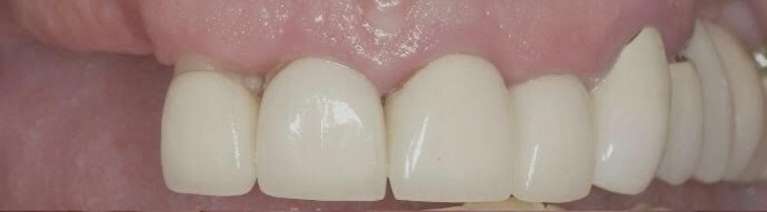 New-Zirconia-Crowns-and-Partial-Denture-Before-Image