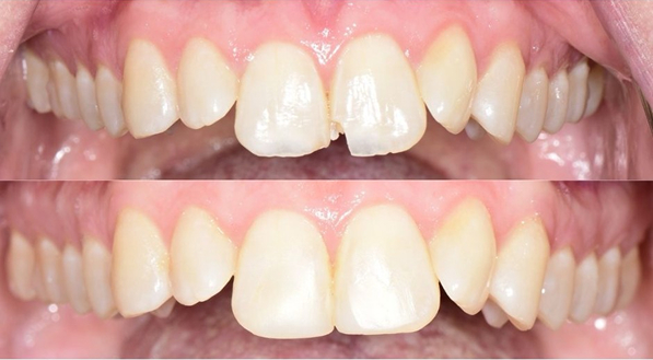 Golden Hill Family Dentistry | Before-and-after comparison of dental work showing a repaired chipped front tooth.