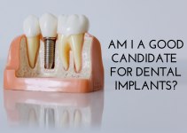 Am I A Good Candidate For Dental Implants